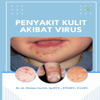 Penyakit Kulit Akibat Virus